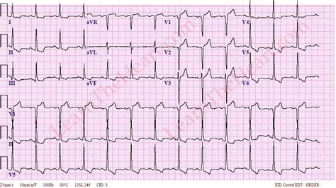 lvh strain pattern ecg